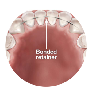 bonded-retainer