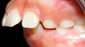 protruding teeth