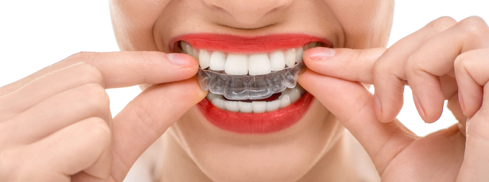 Permanent retainer vs removable which one is best? Insoft & Hurst