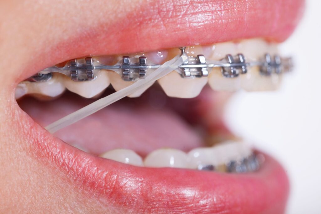 Braces with rubber bands correcting bite, orthodontic elastics for teeth alignment.